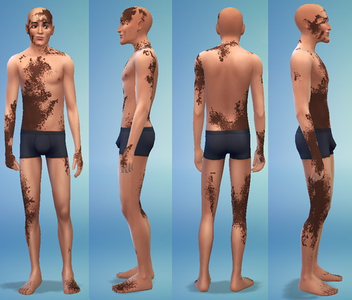 Sims 4 Vitiligo at Jongarakun’s Junk