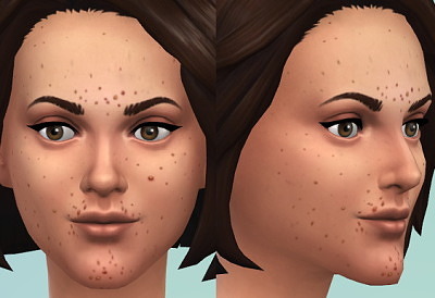 sims 4 slice of life mod acne treatment