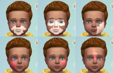 Port Wine Stain & Vitiligo Facial Marks for Toddlers by harlequin_eyes at Mod The Sims